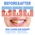 Teeth Repair Gel Swelling And Aching Of Gum Deep Cleaning